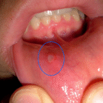Estomatitis aftosa recurrente: desde la úlcera inicial hasta la cicatrización completa.