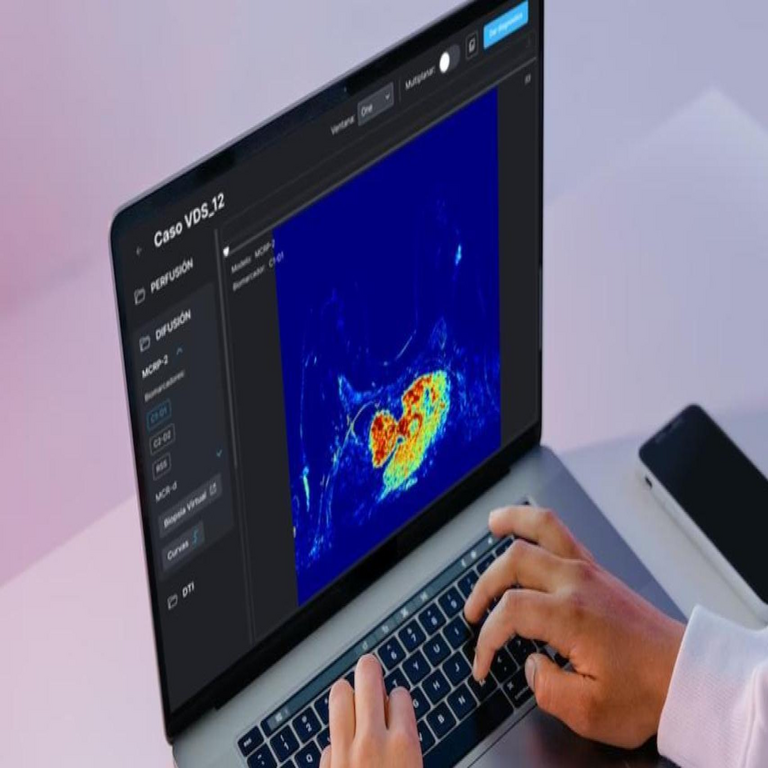 Sistema español para agilizar la detección temprana del cáncer de mama mediante inteligencia artificial: Detectamos tumores del tamaño de un píxel