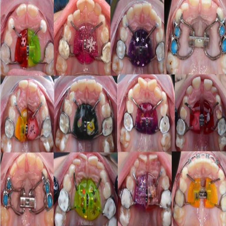 Cómo diseñamos e implantamos dispositivos en forma de mariquitas para niños con el objetivo de mejorar su respiración. Cómo diseñamos e implantamos dispositivos en forma de mariquitas para niños con el objetivo de mejorar su respiración.