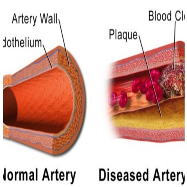 Hilo delicado de la vida: una nueva teoría predice la arquitectura de los trombos mediante el lenguaje de la física.