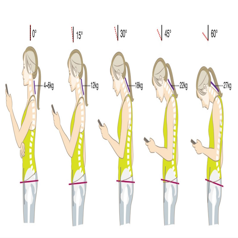 Cómo los problemas de oclusión dental y afecciones bucales pueden agravar el síndrome de cuello por uso de computadora