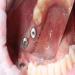 Lo que sucede con el implante en los primeros tres segundos posteriores a su instalación.